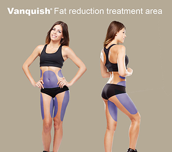 Vanquish fat removal